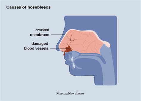 Nosebleeds Causes Treatment And Home Remedies