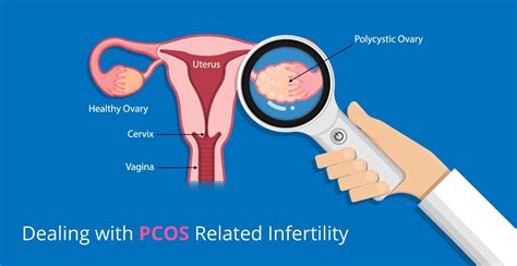 Pcos Infertility Treatment Guidelines Aarush Ivf And Endoscopy Centre