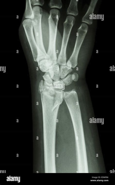 Fiilm X Ray Wrist Show Fracture Distal Radius Forearms Bone Stock