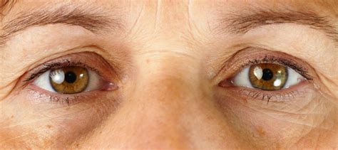 Under Eye Wrinkles Have Surgery Tca Peel Wont Work Scary Symptoms