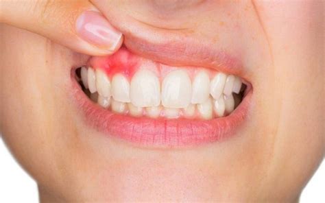 Parodontologia Cura Malattie Parodontali Studio Dentistico Sacco