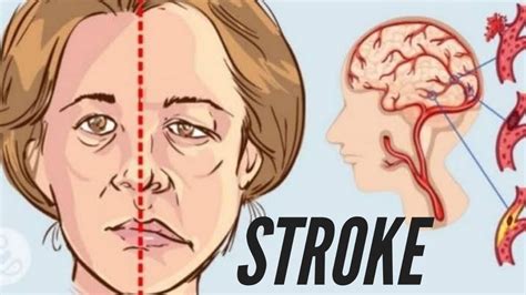 What Happens During A Stroke Youtube