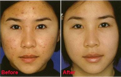 Question that you may have: Vitamin E for acne scars before and after | Skincare Org.