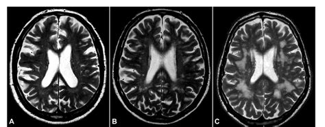 Figure 1 From Small Vessel Disease On Neuroimaging In A 75 Year Old