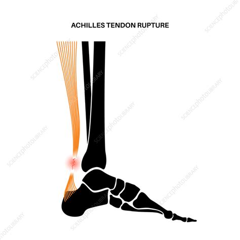 Achilles Tendon Injury Illustration Stock Image F0357107