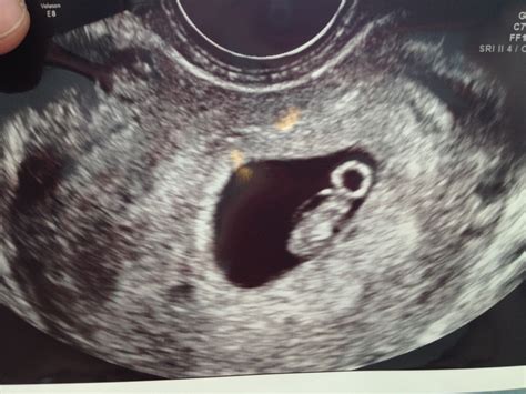 First Ultrasound At 7 Weeks It Was Done Urgently To Determine