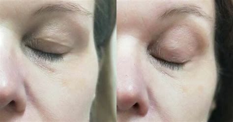 Non Surgical Blepharoplasty Eyelid Tightening Appearance Clinic