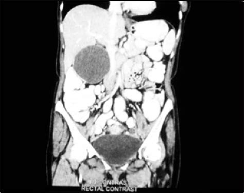 Figure 1 From Primary Peritoneal Papillary Serous Cystadenocarcinoma