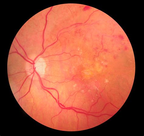 Central Retinal Vein Occlusion Crvo Board Certified Eye Doctors