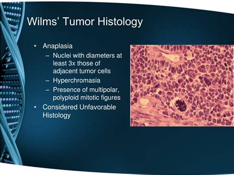 Ppt Pediatric Abdominal Tumors A Focus On Wilms Tumor Powerpoint