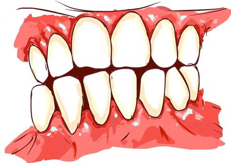 Signs Of Gum Disease Covington Dental