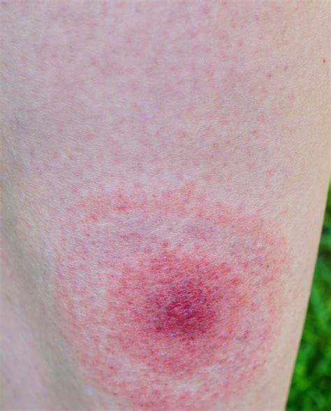 These Pictures Will Help You Id The Most Common Bug Bites And Their