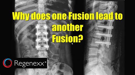 Long Term Fusion Risk