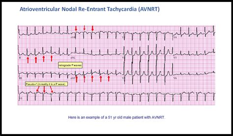 T Av Nodal Reentrant Tachycardia Ecg Made Simple