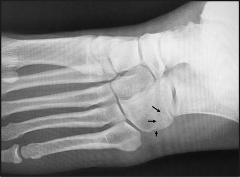 “nutcracker” Cuboid Fracture In A Collegiate Football Player Athletic