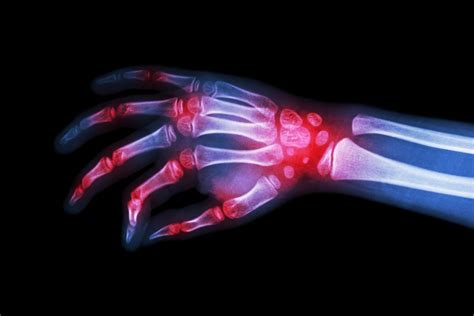 5 Causes Of Wrist Pain You Should Never Ignore Page 4 Of 7 Betahealthy
