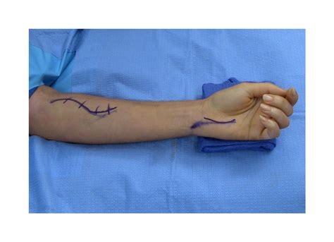 Median Nerve Release In The Forearm Surgical Education Learn