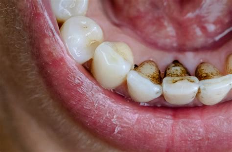 Gingivitis Vs Periodontitis Differences Symptoms And Treatments Rankingsiecipl