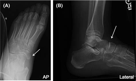 Avulsion Fractures In The Foot Telltale Radiographic Signs To Avoid