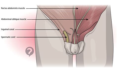Often groin strain occurs in the area of inguinal ligament. Inguinal canal