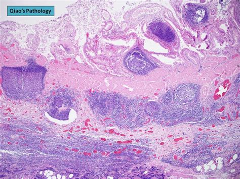 Qiaos Pathology Follicular Cholecystitis With Lymphoid H Flickr