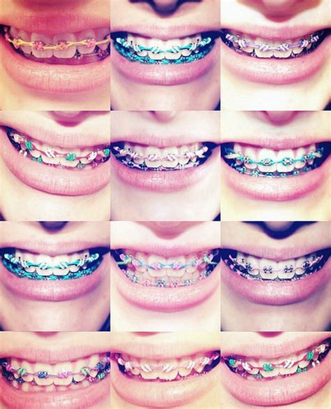 best color braces for teeth teeth braces ideas dental braces braces colors braces bands