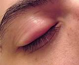 Images of Eyelid Stye Medication