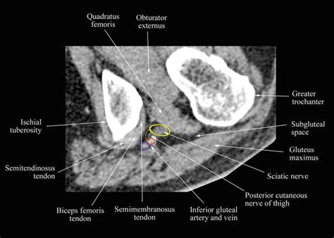 High Definition And Three Dimensional Volumetric Ultrasound Imaging Of