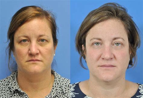 Blepharoplasty Before And After Savannah Facial Plastic Surgery