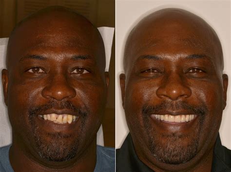 All On Dental Implants Photos Miami Patient