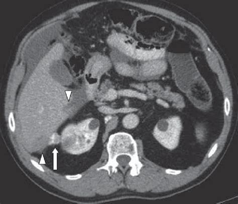 Ct Scan Of The Upper Abdomen After Iodine Contrast Injection Showing