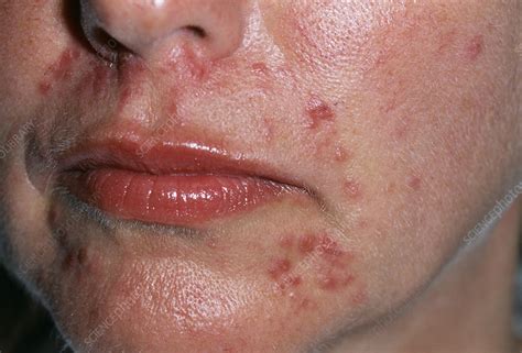 Acne Rosacea Stock Image M2500052 Science Photo Library