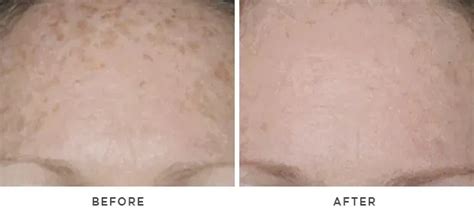 Chemical Peels Houston Tx Dermatologist