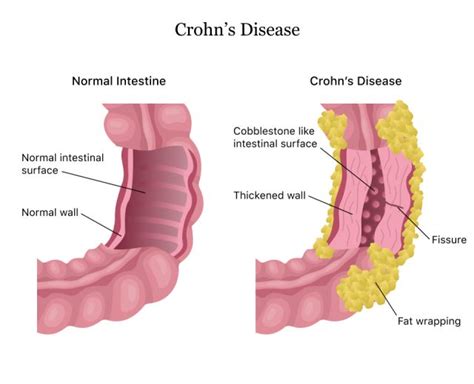 Crohns Disease Causes Symptoms Diagnosis Treatment