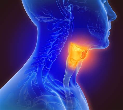 C Ncer De Laringe Os Principais Sintomas Da Doen A Meionorte