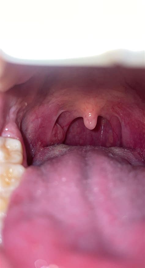 Enlarged Tonsil Weird Papillae On Tongue Tonsil Stones Are In There