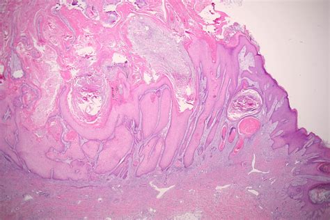 Keratoacanthoma Squamous Cell Carcinoma Of The Keratoacanthoma Type