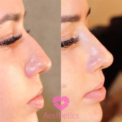 Our Non Surgical Nose Job Is Used To Straighten The Nose Andor Create