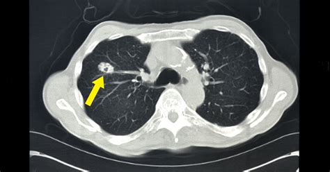 Chest Xray For Diagnosis Of Lung Cancer