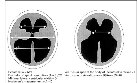 Frontal And Occipital Horn Ratio A Linear Estimate Of Ventricular Size