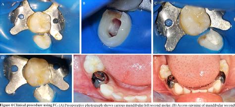 Efficacy Of Aloe Vera As A Pulpotomy Agent In Children Primary Teeth