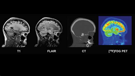 New Database Of Healthy Adult Human Brain Pet Mri And Ct Images Is Now