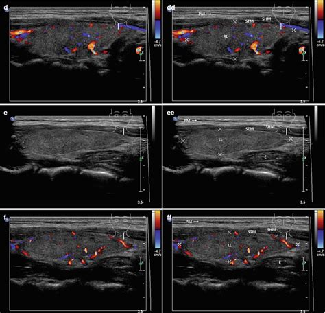 Normal Ultrasound Of Thyroid Gland And Lymph Nodes Radiology Key