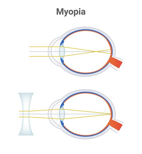 Myopia Short Sightedness Or Near Sightedness Eye Disorder And Corrected Eye By A Minus Lens Or