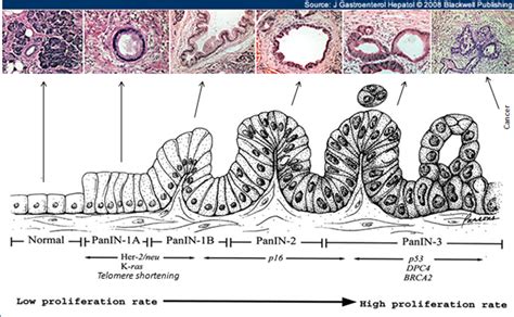 (1) pancreatic cancer cells proliferate in the primary tumour. Team:ESBS-Strasbourg/proteolux/application/cancer - 2010 ...