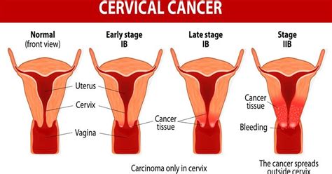 Warning Symptoms Of Cervical Cancer That Every Women Should Know