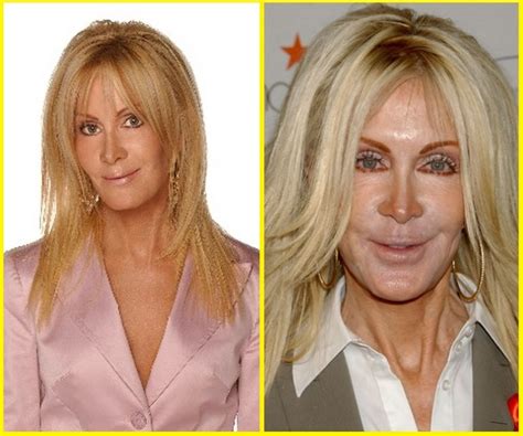 10 Celebrity Plastic Surgery Disasters Before And After