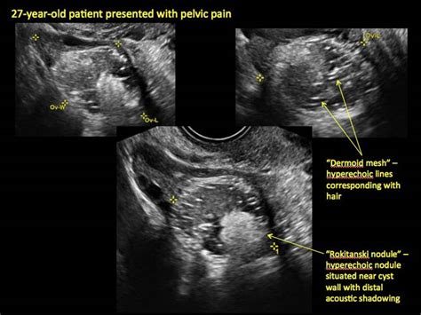 Imaging The Endometrioma And Mature Cystic Teratoma Mdedge Obgyn