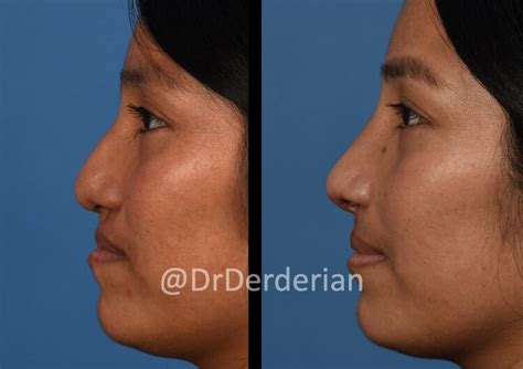 Adult Cleft Rhinoplasty — Dr Derderian — Plastic And Reconstructive Surgery