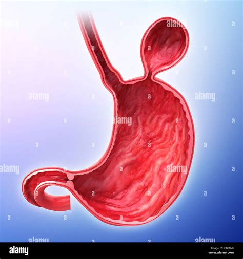 Human Stomach With Hernia Artwork Hi Res Stock Photography And Images
